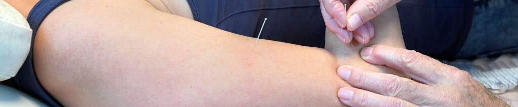 Acupunctuur